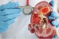 Ilustrasi gangguan ginjal akut. [Antara]