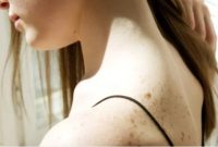 Ilustrasi seseorang dengan jerawat di badan (Pexels/Anna Nekrasevich)