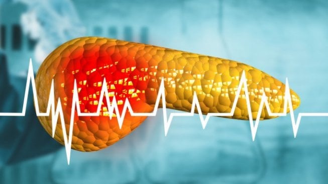 Ilustrasi kanker pankreas (sumber: suara.com)